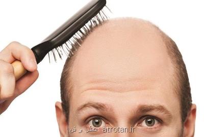 ۵۰ درصد ایرانیان مشكل ریزش موی سر دارند
