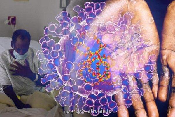 افزایش مجدد موارد مبتلاشدن به آبله میمون در آمریکا