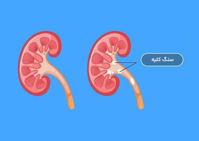 دفع سنگ کلیه قطعی
