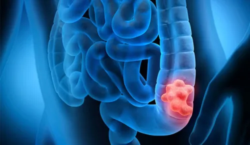 مصرف مشروبات الکلی خطر مبتلا شدن به سرطان روده بزرگ را بیشتر می کند