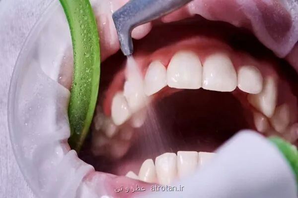 جرم گیری، راهی موثر برای پیش گیری از پوسیدگی و بیماری لثه