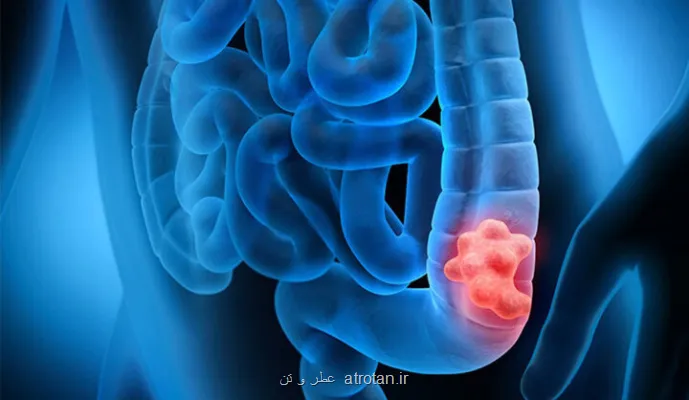 مصرف مشروبات الکلی خطر مبتلا شدن به سرطان روده بزرگ را بیشتر می کند